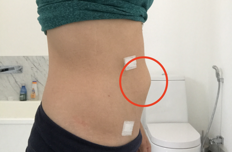 Como está sendo a recuperação da Colecistectomia (retirada da vesícula)