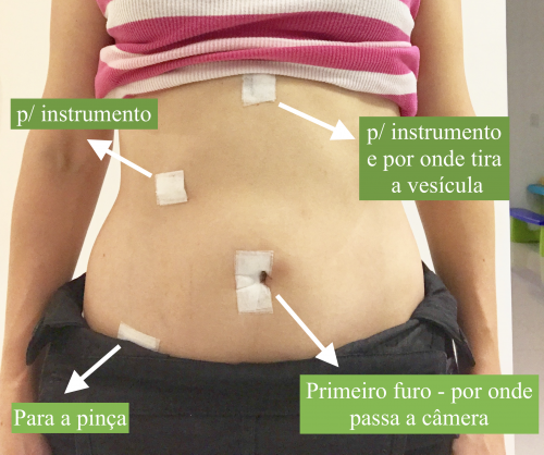 cirurgia-retirada-de-vesicula-colecistectomia