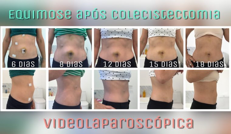 equimose-cirurgia-videolaparoscopia