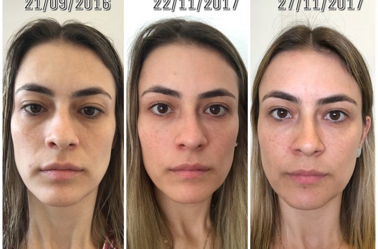 1 ano após o preenchimento nas olheiras